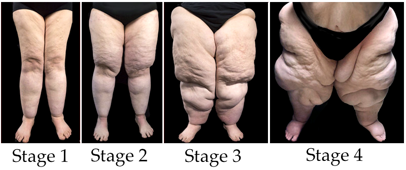The 4 stages of lipoedema